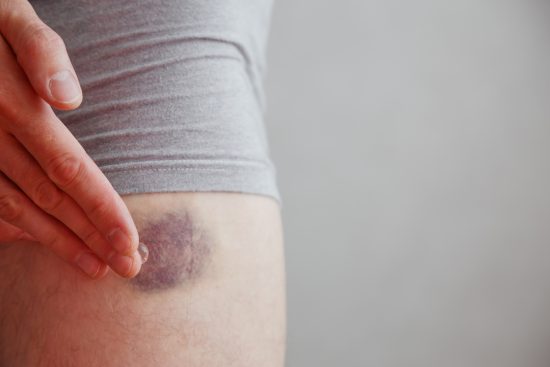 moreton, hematoma, equimosis, piel, sangrado interno, Causes of easy bruising: When should you worry?