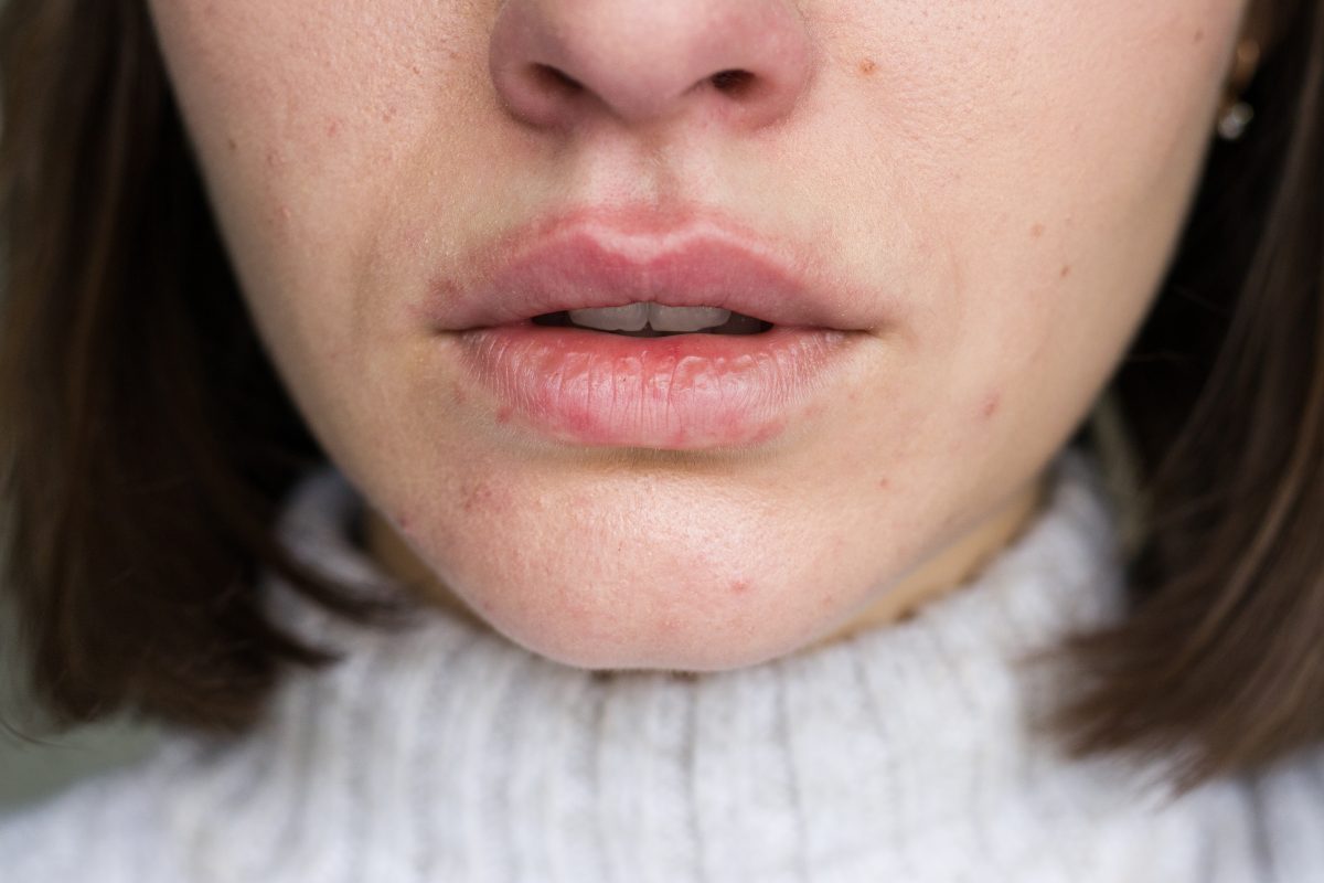 labios agrietados, Chapped lips winter remedies that really work