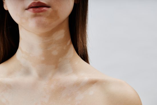 vitiligo pisibles causas, All About Vitiligo: Causes, Symptoms, and Available Treatments!