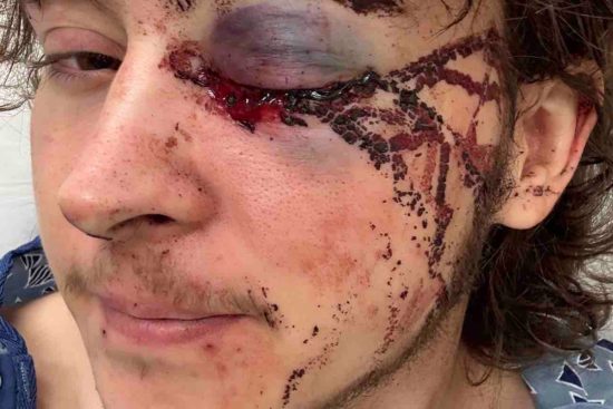 Joven pierde un ojo, Protesta contra ICE, Uso de fuerza MundoNOW, Anti-ICE Protest Shooting Leaves Young Man With Permanent Injuries