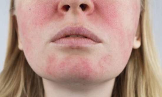 mes de la rosacea piel doctor, sintomas